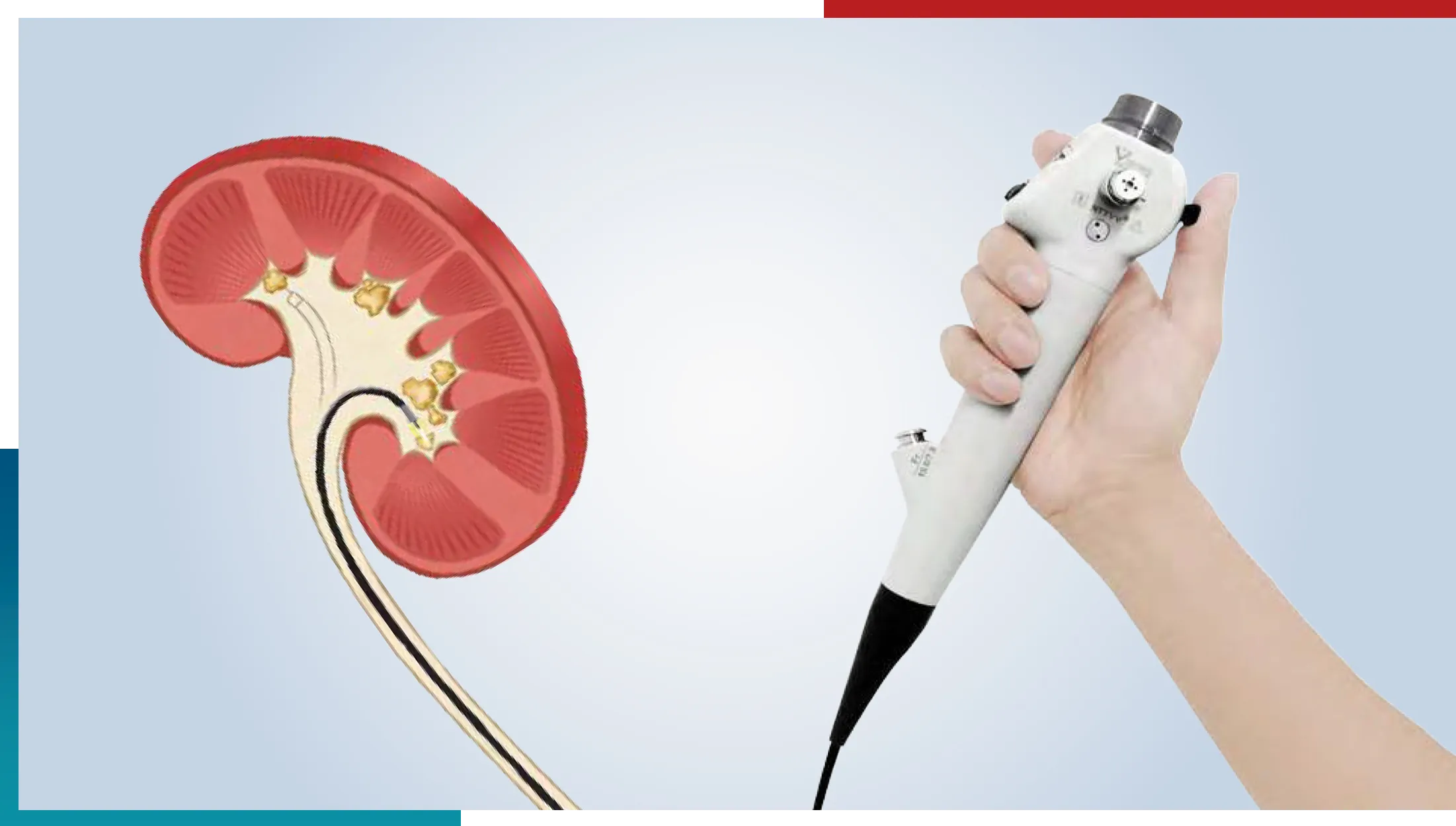 Видеоуретерореноскоп